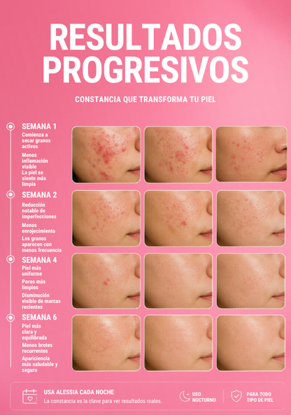 ALESSIA Tratamiento Secante Anti Acné Nocturno para Granos